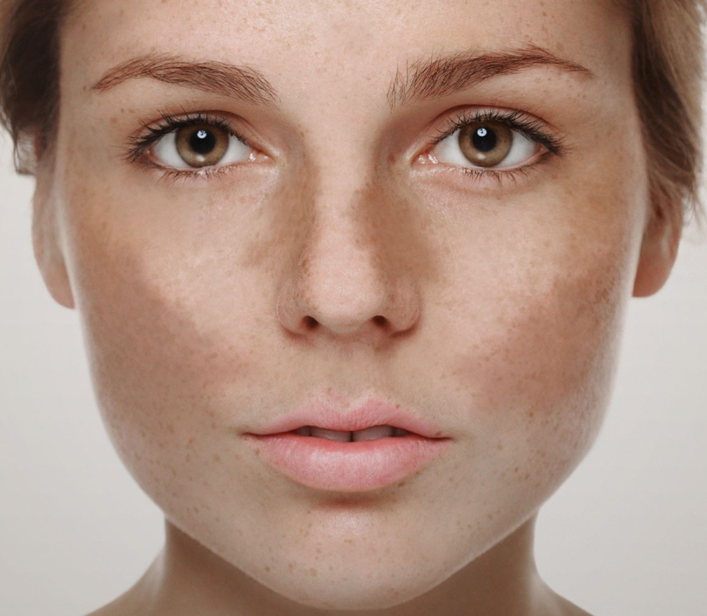 Melasma pigmentation treatment in Bahrain