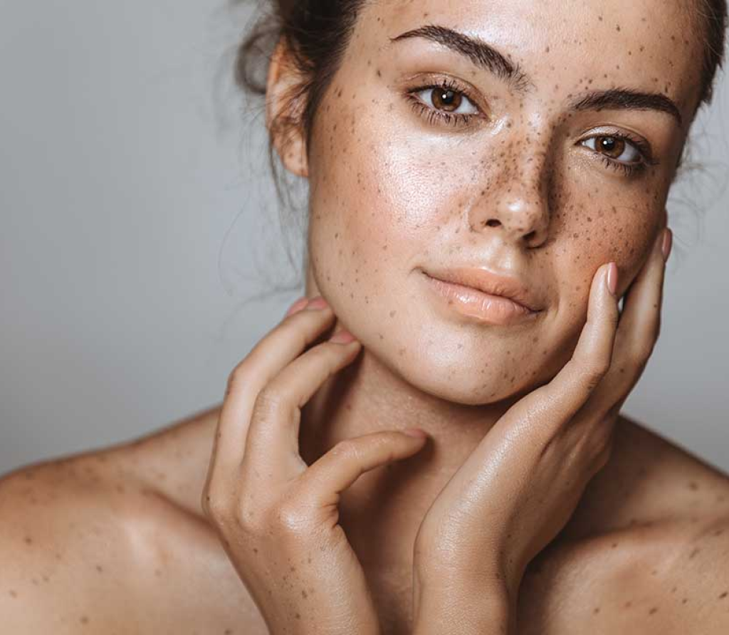 Melasma treatment in Bahrain