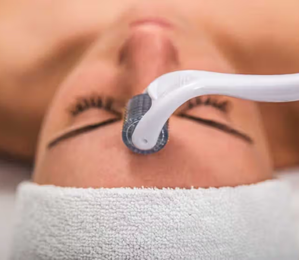 Microneedling Treatment