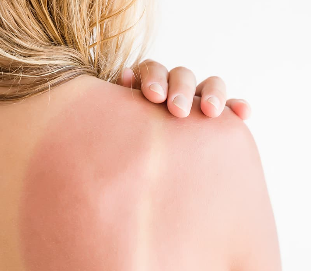 Sunburn treatment in Bahrain