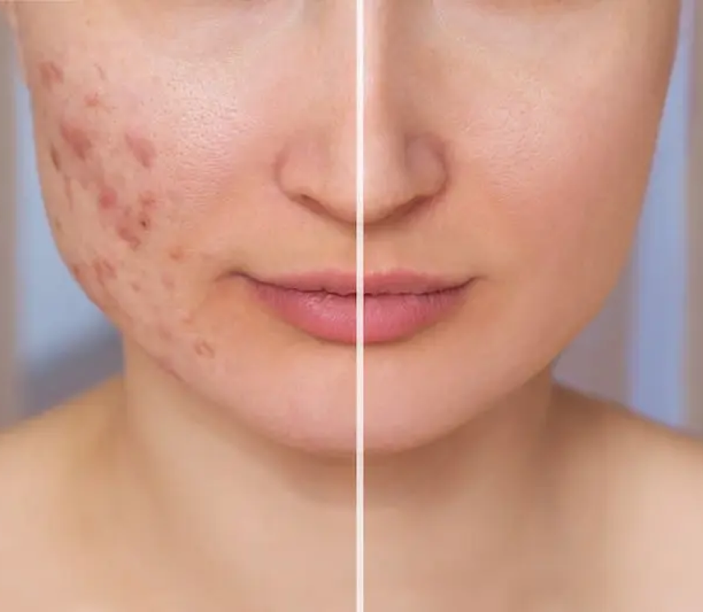 Acne scar treatment in Bahrain