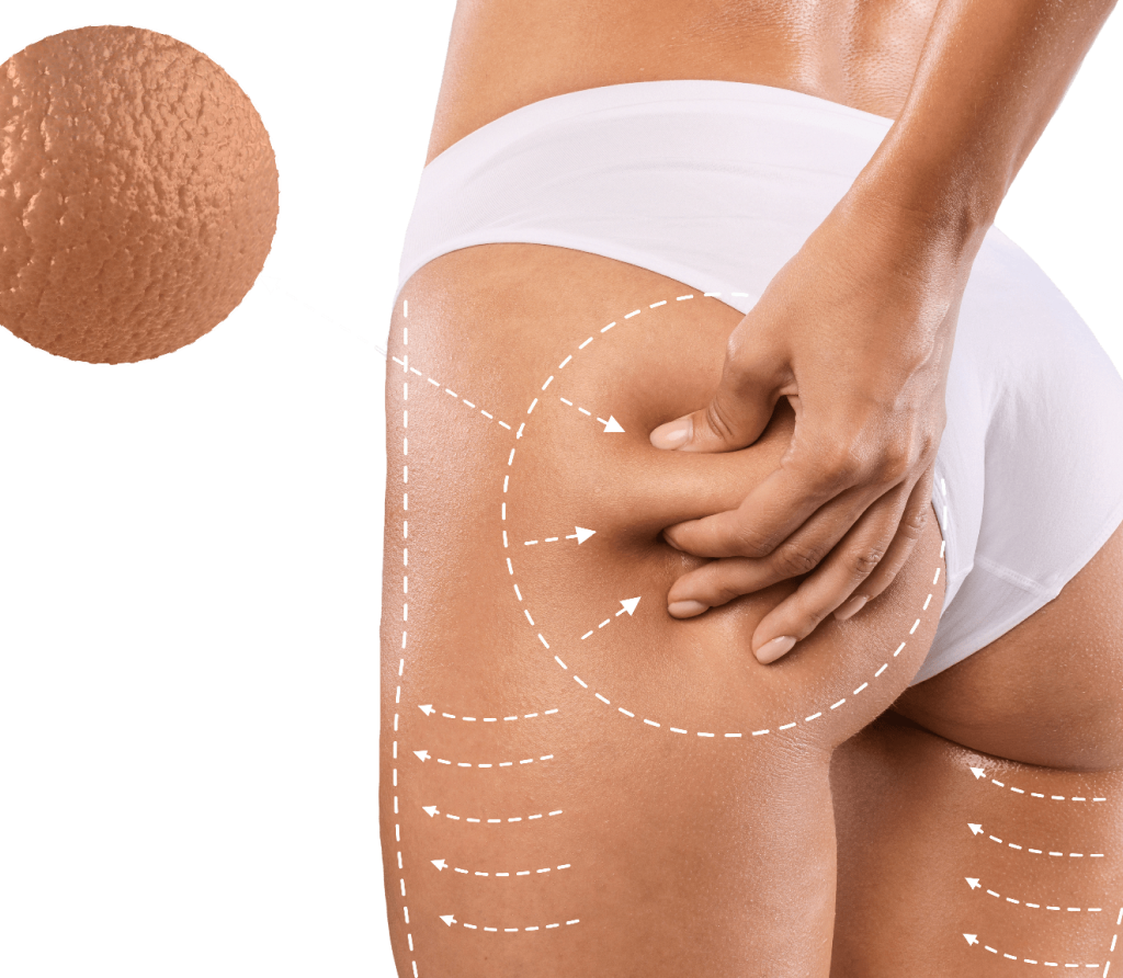 Cellulite Reduction in Bahrain