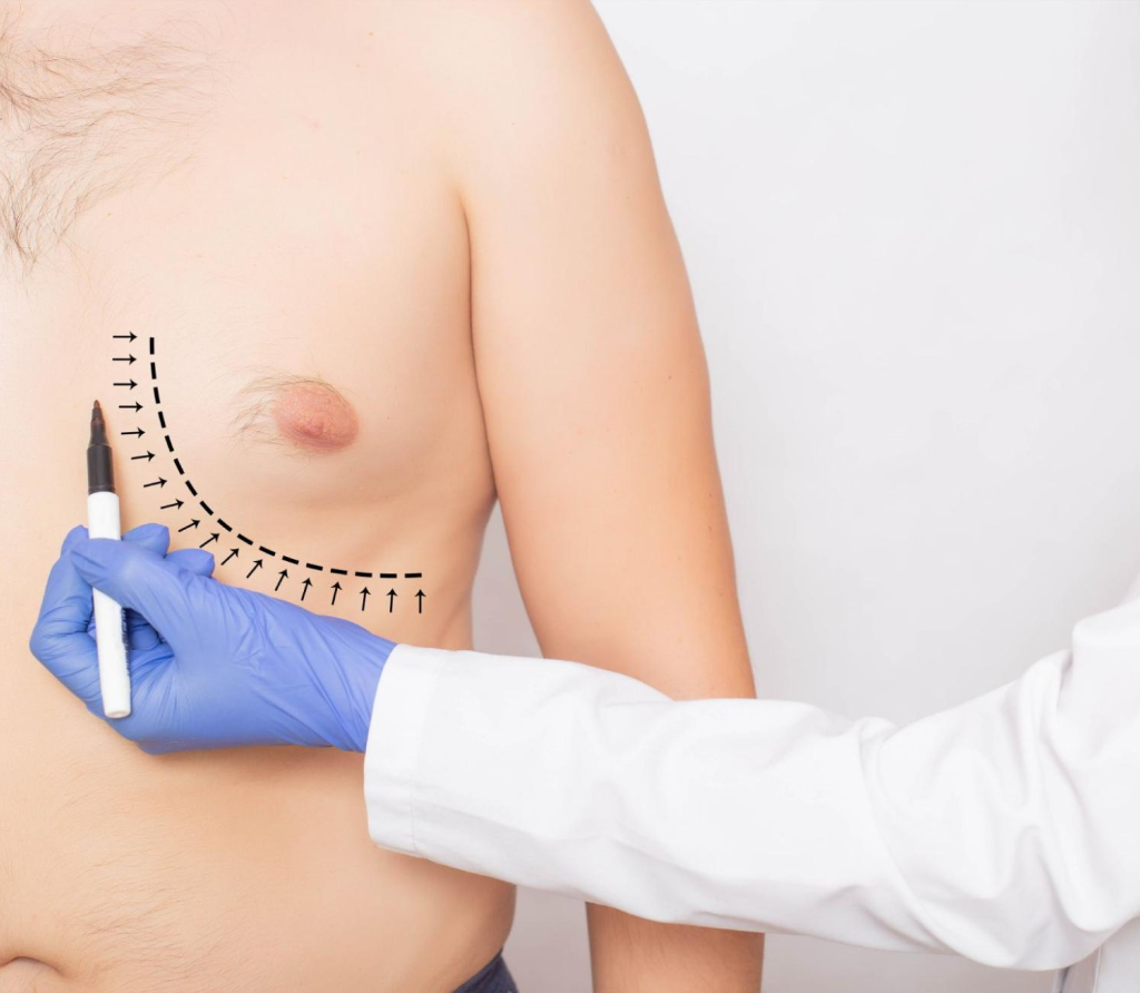 Gynecomastia surgery in Bahrain