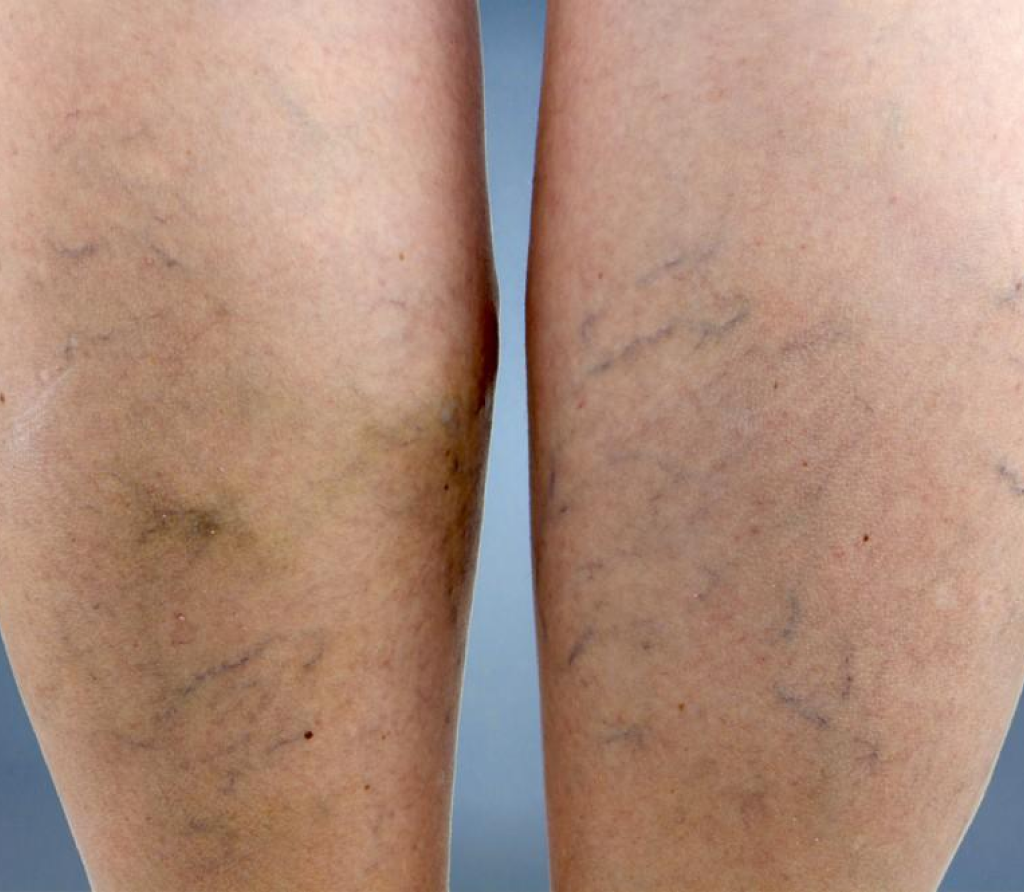 Varicose veins treatment in Bahrain